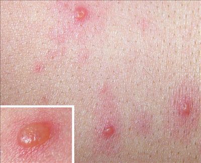 皰疹圖片